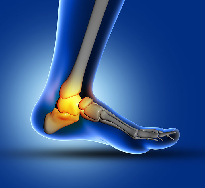 Calcaneal fracture